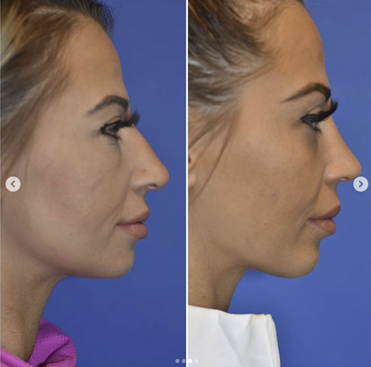 rhinoplasty in seattle